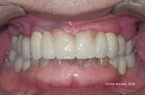 Fixed partial overdenture on implants