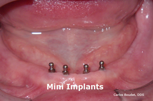 Mini Implants placed by Carlos Boudet, DDS , DICOI